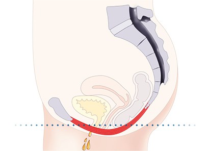 Pelvic-Floor Muscle Repair 5 Pelvic floor muscles Shoreham Beach