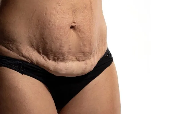 The science behind skin tightening Shoreham Beach picture of a woman's sagging skin on the stomach